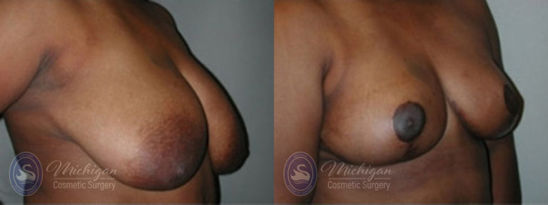 Breast Lift Before and After Photo by Dr. Awada in Southfield Michigan