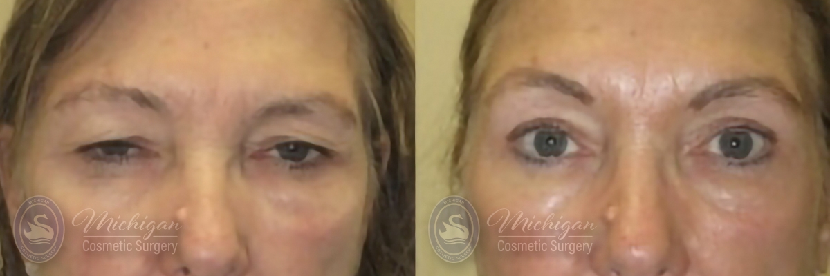 Brow Lift Procedure In Michigan by Dr. Awada