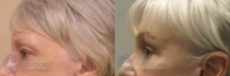 Brow Lift Before and After Photo by Dr. Awada in Southfield Michigan