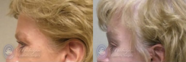 Brow Lift Before and After Photo by Dr. Awada in Southfield Michigan