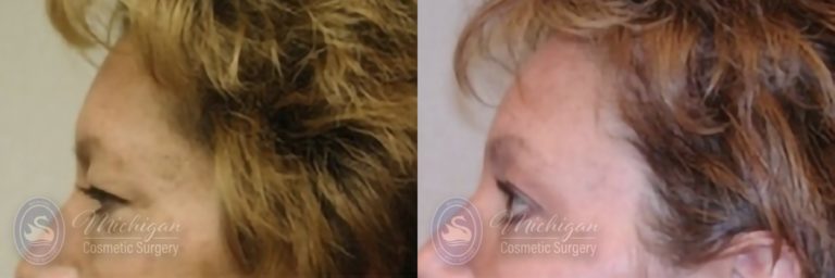 Brow Lift Before and After Photo by Dr. Awada in Southfield Michigan