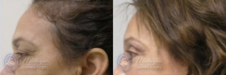 Brow Lift Before and After Photo by Dr. Awada in Southfield Michigan