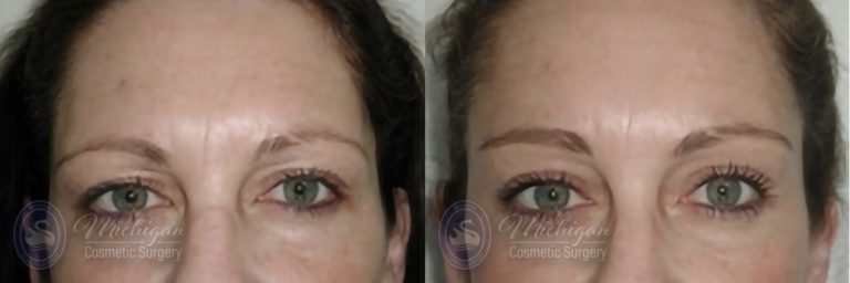Brow Lift Before and After Photo by Dr. Awada in Southfield Michigan