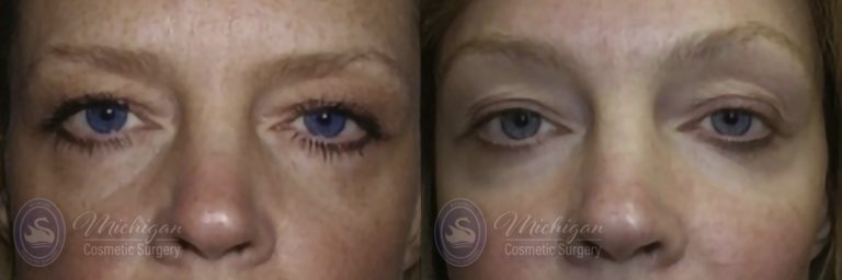 Brow Lift Before and After Photo by Dr. Awada in Southfield Michigan