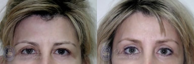 Brow Lift Before and After Photo by Dr. Awada in Southfield Michigan