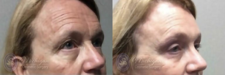 Brow Lift Before and After Photo by Dr. Awada in Southfield Michigan