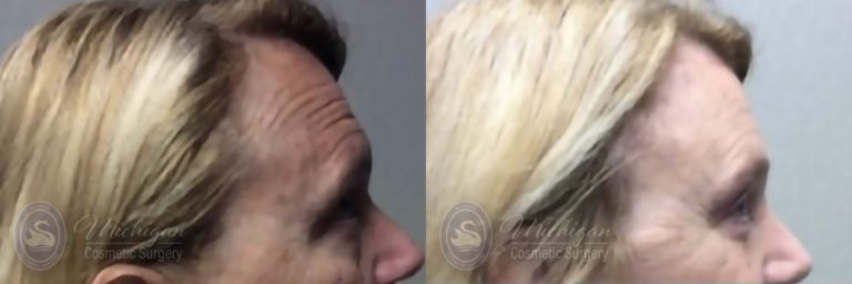 Brow Lift Before and After Photo by Dr. Awada in Southfield Michigan