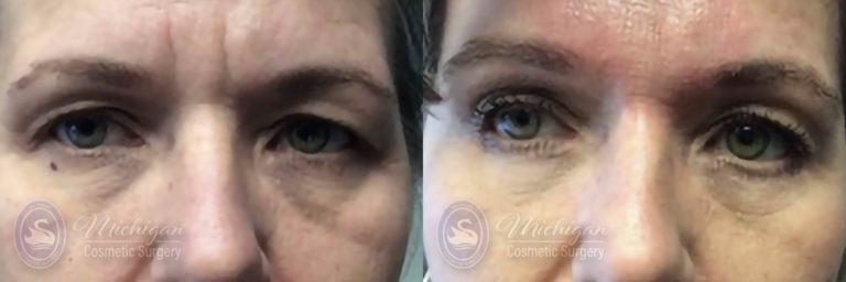 Brow Lift Before and After Photo by Dr. Awada in Southfield Michigan
