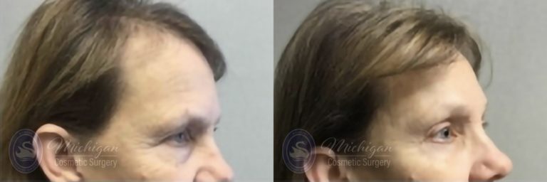 Brow Lift Before and After Photo by Dr. Awada in Southfield Michigan
