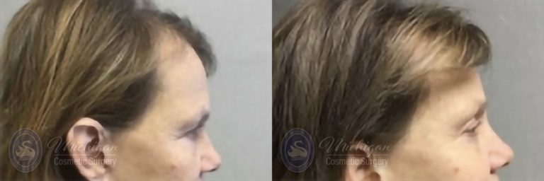 Brow Lift Before and After Photo by Dr. Awada in Southfield Michigan