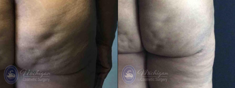 Cellulite Treatment Before and After Photo by Dr. Awada in Southfield Michigan