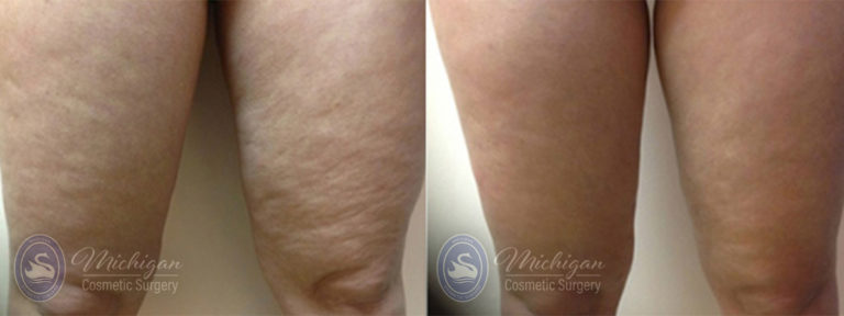 Cellulite Treatment Before and After Photo by Dr. Awada in Southfield Michigan
