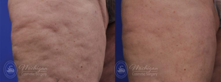 Cellulite Treatment Before and After Photo by Dr. Awada in Southfield Michigan