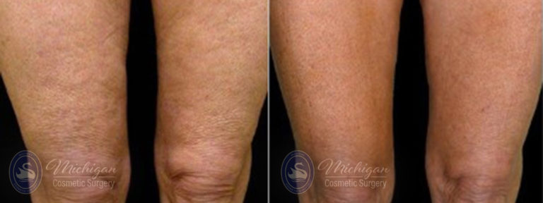 Cellulite Treatment Before and After Photo by Dr. Awada in Southfield Michigan