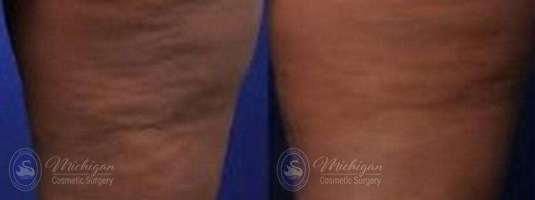 Cellulite Treatment Before and After Photo by Dr. Awada in Southfield Michigan