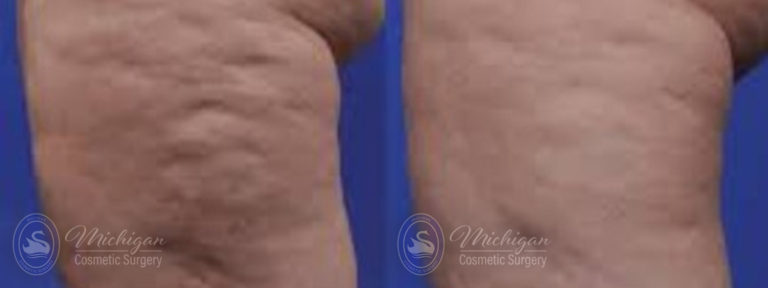 Cellulite Treatment Before and After Photo by Dr. Awada in Southfield Michigan
