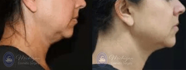 CoolSculpting Before and After Photo by Dr. Awada in Southfield Michigan