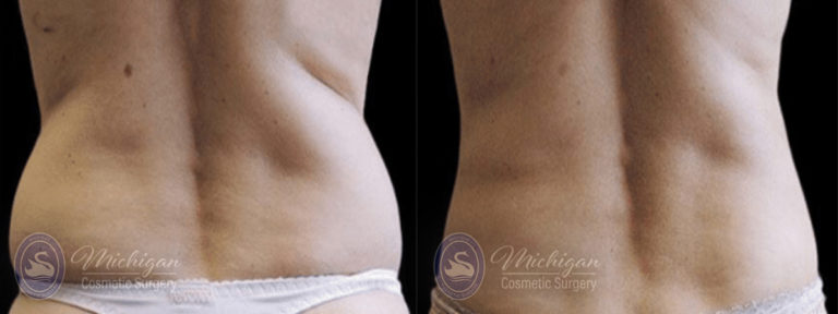 CoolSculpting Before and After Photo by Dr. Awada in Southfield Michigan