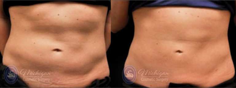 CoolSculpting Before and After Photo by Dr. Awada in Southfield Michigan