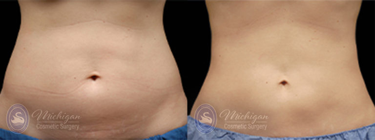 CoolSculpting Before and After Photo by Dr. Awada in Southfield Michigan