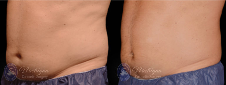 CoolSculpting Before and After Photo by Dr. Awada in Southfield Michigan