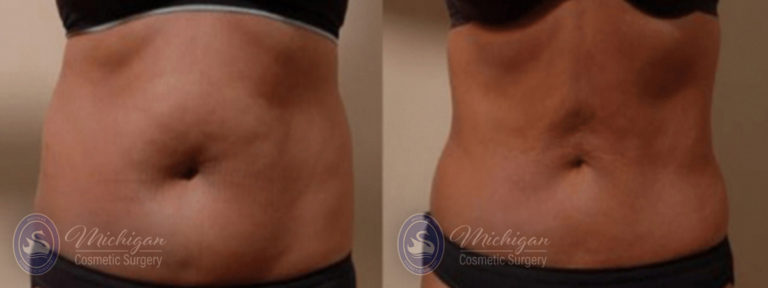 CoolSculpting Before and After Photo by Dr. Awada in Southfield Michigan