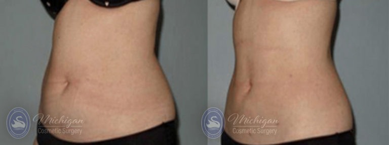 CoolSculpting Before and After Photo by Dr. Awada in Southfield Michigan