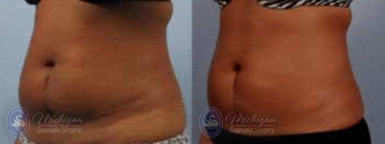 CoolSculpting Before and After Photo by Dr. Awada in Southfield Michigan