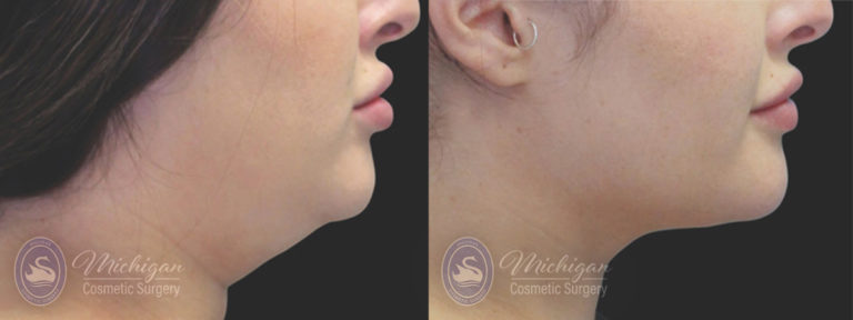 CoolSculpting Before and After Photo by Dr. Awada in Southfield Michigan