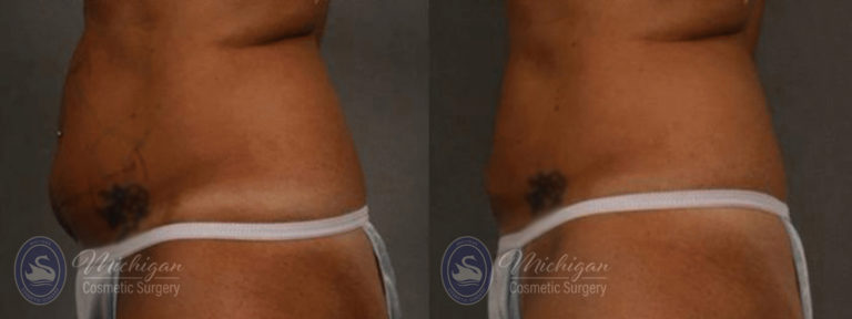 CoolSculpting Before and After Photo by Dr. Awada in Southfield Michigan