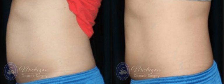 CoolSculpting Before and After Photo by Dr. Awada in Southfield Michigan