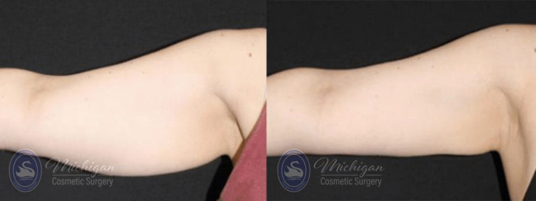 CoolSculpting Before and After Photo by Dr. Awada in Southfield Michigan