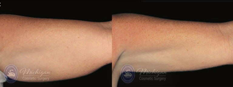 CoolSculpting Before and After Photo by Dr. Awada in Southfield Michigan