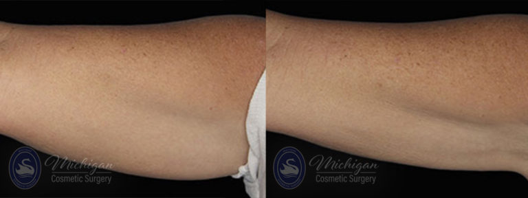 CoolSculpting Before and After Photo by Dr. Awada in Southfield Michigan