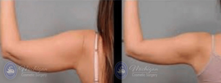 CoolSculpting Before and After Photo by Dr. Awada in Southfield Michigan
