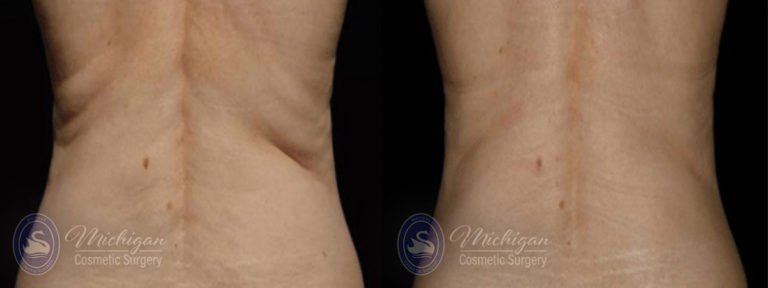 CoolSculpting Before and After Photo by Dr. Awada in Southfield Michigan