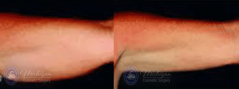 CoolSculpting Before and After Photo by Dr. Awada in Southfield Michigan
