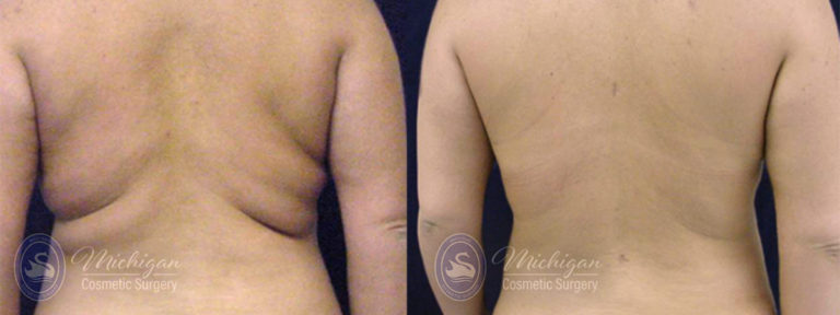 CoolSculpting Before and After Photo by Dr. Awada in Southfield Michigan
