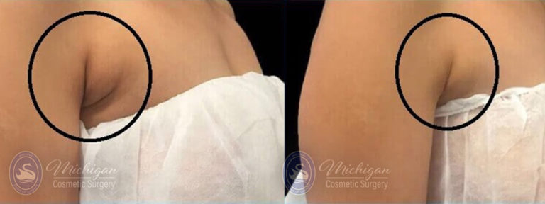 CoolSculpting Before and After Photo by Dr. Awada in Southfield Michigan