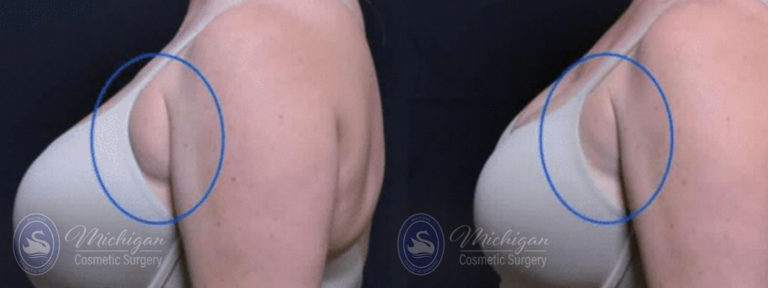 CoolSculpting Before and After Photo by Dr. Awada in Southfield Michigan