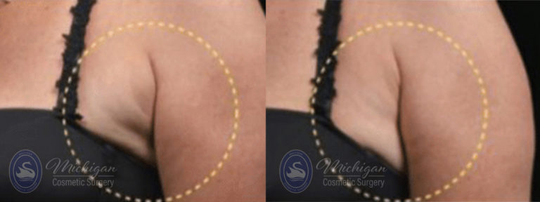 CoolSculpting Before and After Photo by Dr. Awada in Southfield Michigan