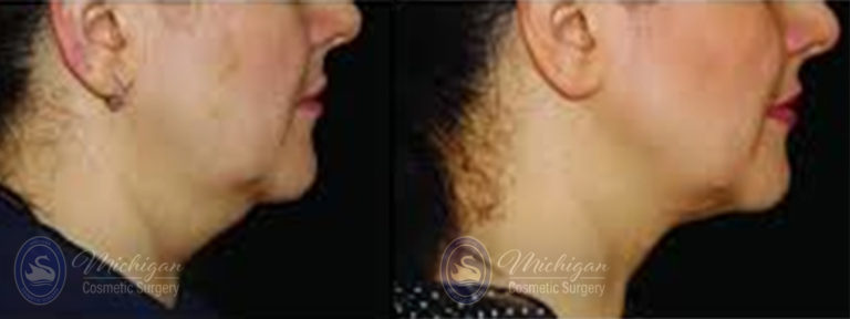 CoolSculpting Before and After Photo by Dr. Awada in Southfield Michigan