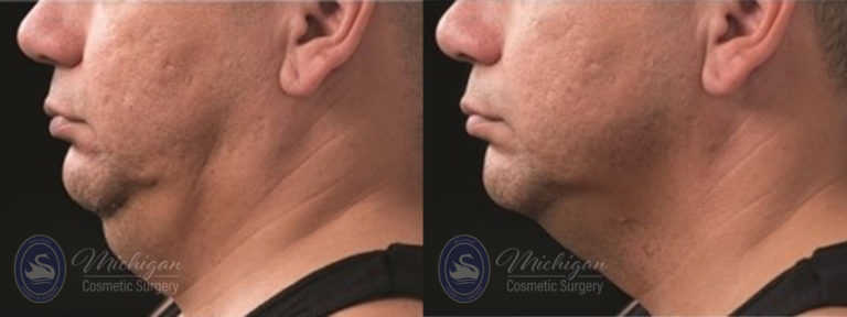 CoolSculpting Before and After Photo by Dr. Awada in Southfield Michigan