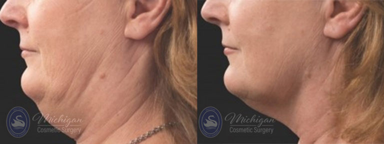 CoolSculpting Before and After Photo by Dr. Awada in Southfield Michigan