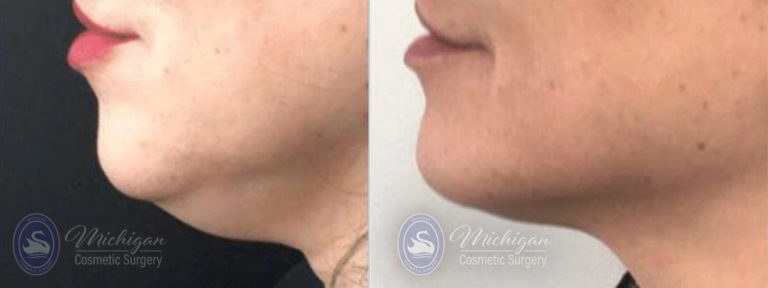 CoolSculpting Before and After Photo by Dr. Awada in Southfield Michigan