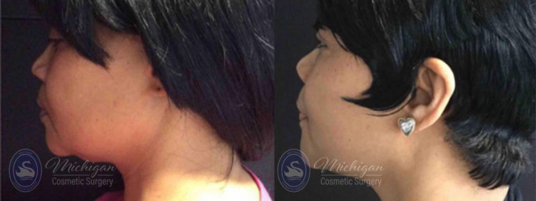 CoolSculpting Before and After Photo by Dr. Awada in Southfield Michigan