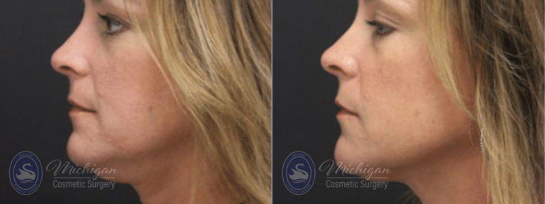 CoolSculpting Before and After Photo by Dr. Awada in Southfield Michigan