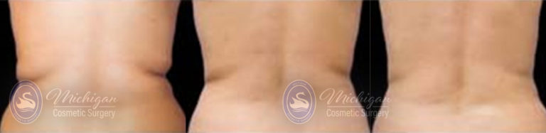 CoolSculpting Before and After Photo by Dr. Awada in Southfield Michigan