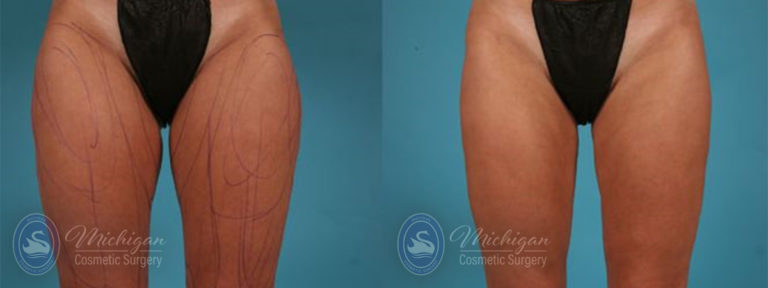 CoolSculpting Before and After Photo by Dr. Awada in Southfield Michigan