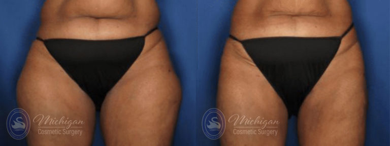 CoolSculpting Before and After Photo by Dr. Awada in Southfield Michigan
